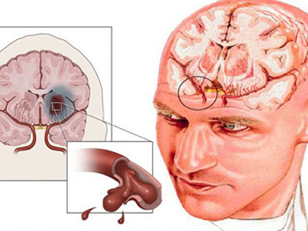 Ишемический инсульт в бассейне правой средней мозговой артерии