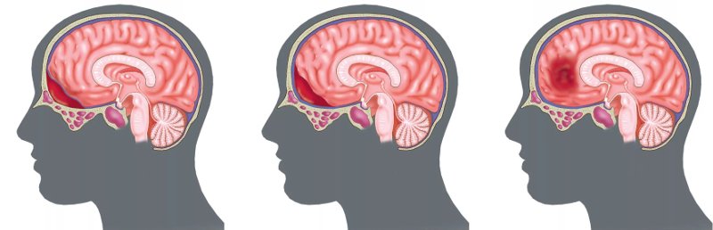 субарахноидальное кровоизлияние в мозг