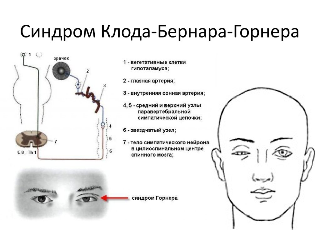 Opuhol Spinnogo Mozga Prichiny Simptomy Diagnostika Lechenie