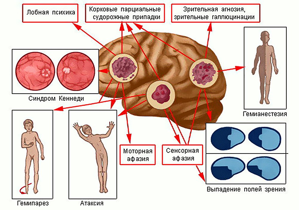 опухоль головного мозга операция в Москве