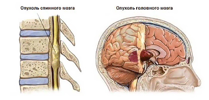 Лечение опухоли головного мозга в Москве