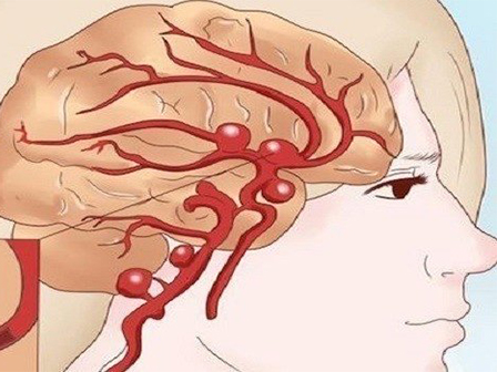 Последствия субарахноидального кровоизлияния в головном мозге