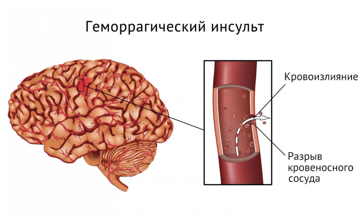 Лечение геморрагического инсульта в Москве