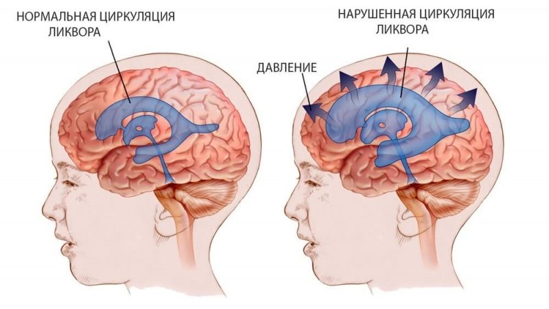 Гидроцефалия головного мозга у взрослых и детей: причины, симптомы, лечение