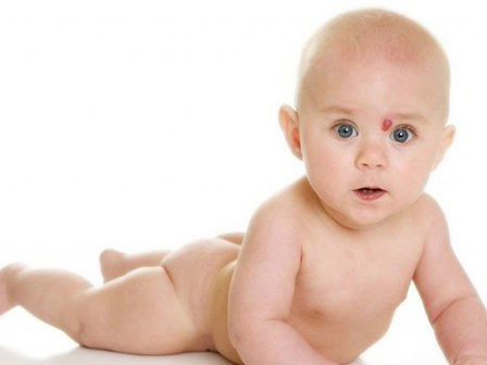 Гемангиома у новорожденных – причины возникновения и лечение
