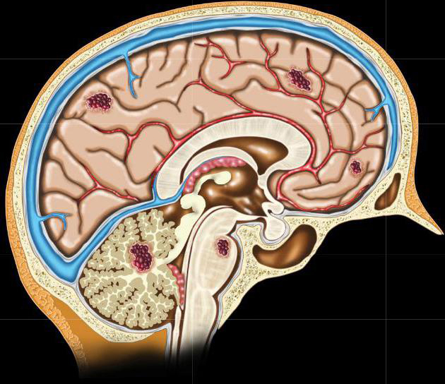 Гемангиома головного мозга фото