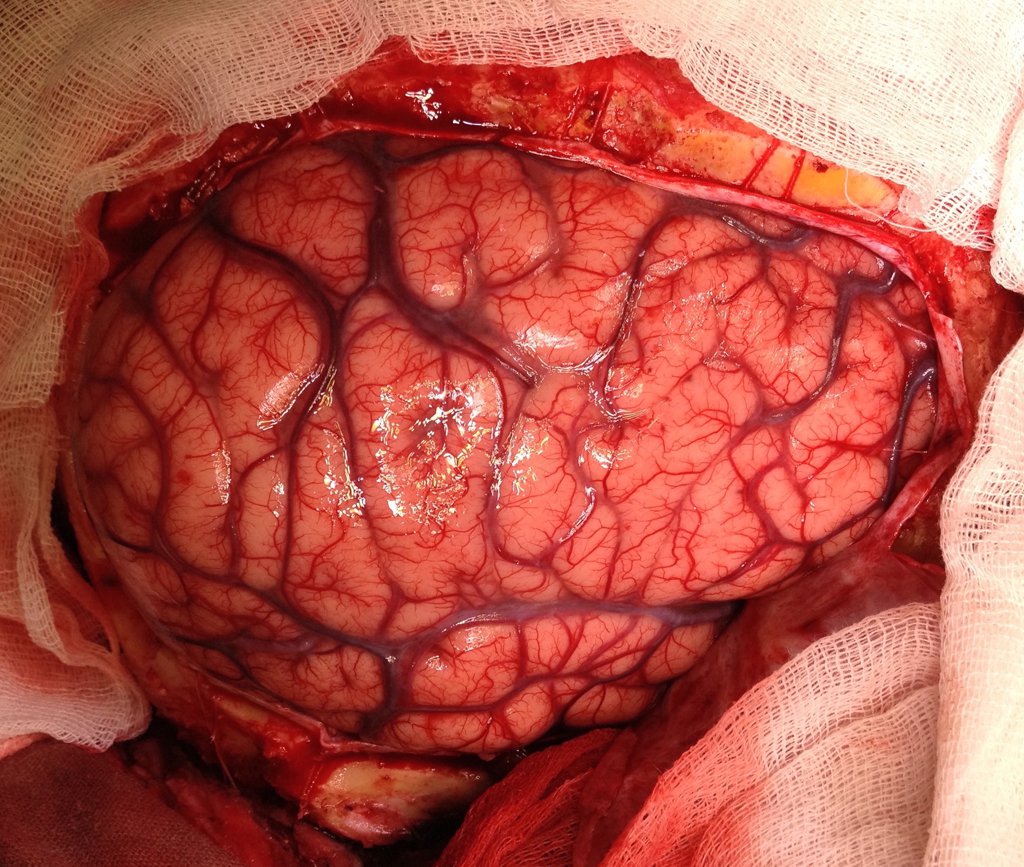 Ишемический инсульт в бассейне правой средней мозговой артерии лечение thumbnail