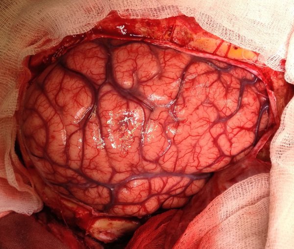 Инсульт в басейне правой средней мозговой артерии