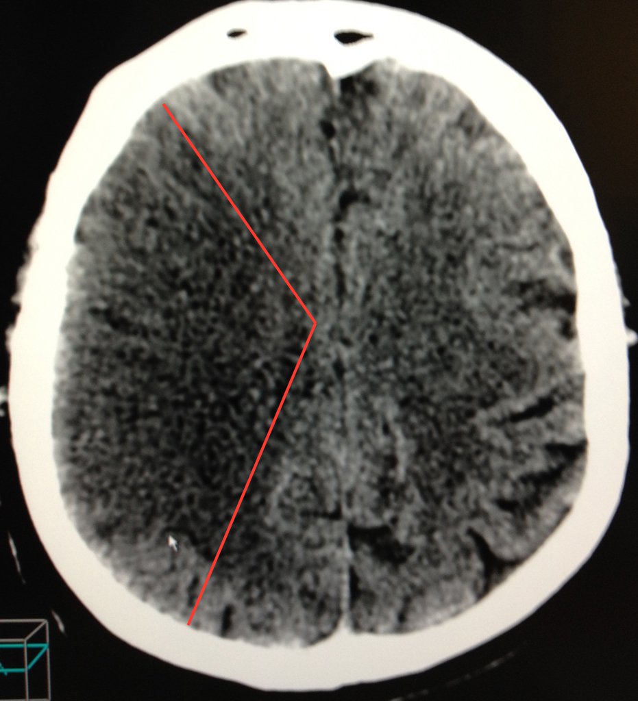 Ишемический инсульт в бассейне правой средней мозговой артерии история