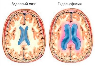 Внешняя гидроцефалия головная боль