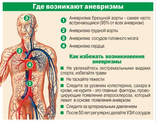 Лечение аневризмы брюшной аорты, операция аневризмы брюшной полости: цена в СПб