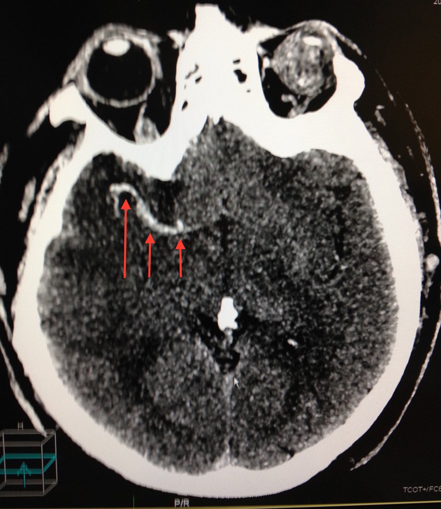 Ишемический инсульт в бассейне правой средней мозговой артерии лечение