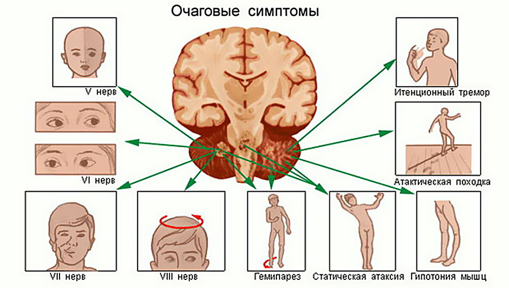Опухоли головного и спинного мозга